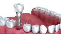 Dental Implants