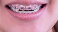 Braces