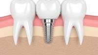 Dental Implants