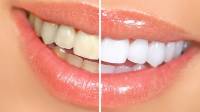 Teeth Whitening