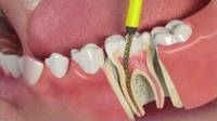 Root Canals