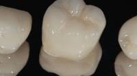 Dental Crowns