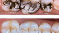 Cavity Fillings