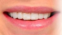 Porcelain Veneers