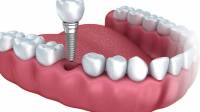 Bone Grafting