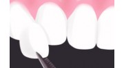 Dental Veneers