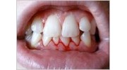 Gum Disease Treatment