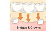 Dental Bridge