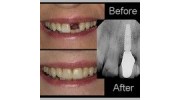 Dental Implants