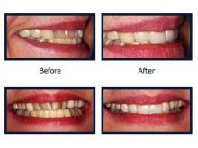 Beautiful Smiles in Chester County with Veneers