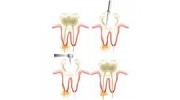 Root Canal