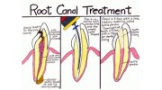 Root Canal Therapy