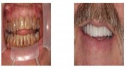 Porcelain Veneers