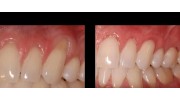 Chao Pinhole® Gum Rejuvenation