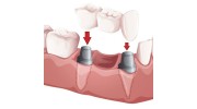 Dental Bridges