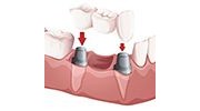 Dental Bridges