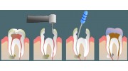 Root Canal Therapy