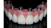 Implant Dentures