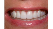 Valdosta Porcelain Veneers