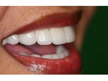 Dental Implants, Veneers, Smile Makeovers: Our Patient's New Smile